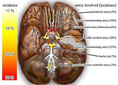 Места возникновения аневризмы мозга