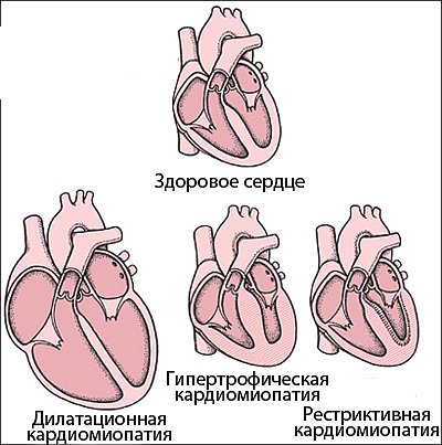 Виды кардиомиопатий