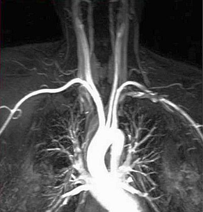 Контрастная МР ангиография брахиоцефальных артерий