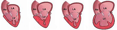 Типы кардиомипатий сердца