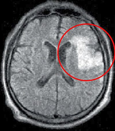 МРТ ишемического инсульта